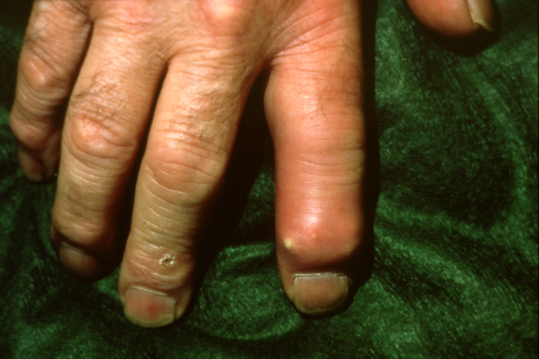 GOUT Hand Surgery Source
